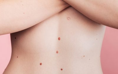 ¿Cómo eliminar las verrugas genitales de forma segura y eficaz?