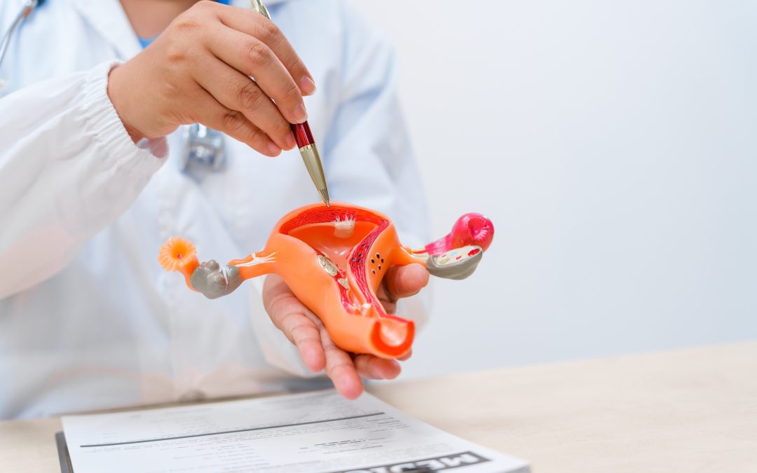 Quiste ovárico: síntomas frecuentes y cuándo acudir a revisión médica